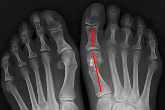 Cirugía Osteoarticular en Barcelona | Clínica Podologia i l'Esport
